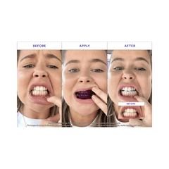 Comparison images of teeth before, applying, and after using whitening strips