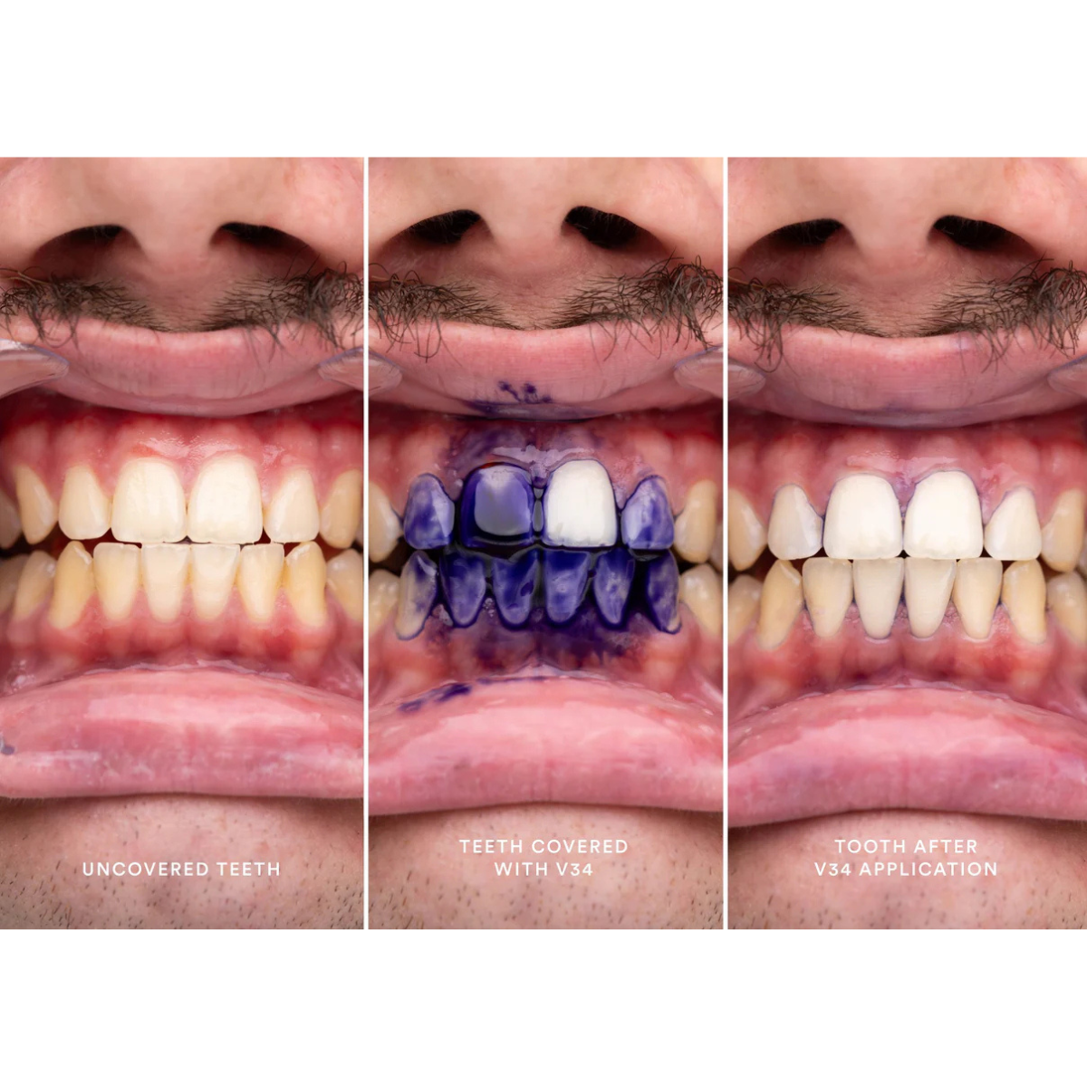 Hismile V34 Purple Teeth Brightening Serum, 1 fl oz