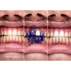 Suero Blanqueador Dental Morado Hismile V34, 30 ml